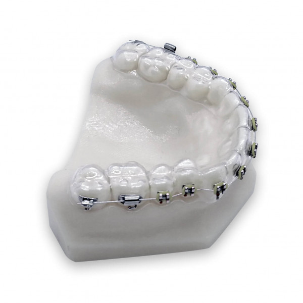Clear Retainer with Brackets