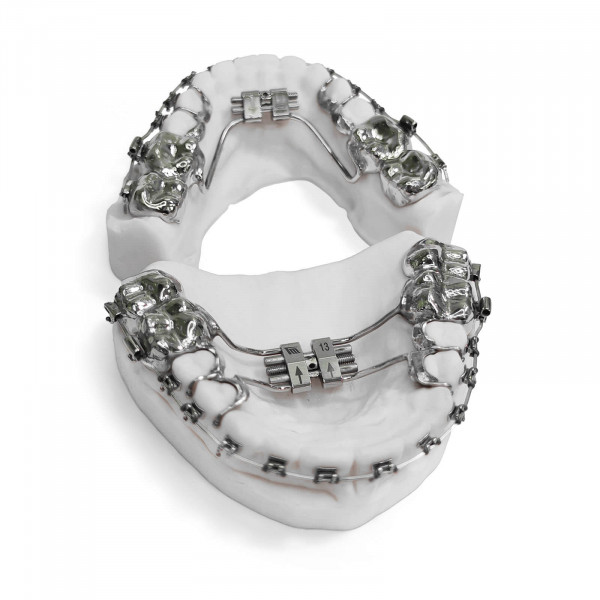 Bracket Appliance with RPE