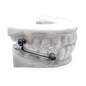 Clear Retainer with Herbst Appliance