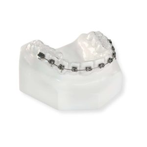 Clear Retainer with Brackets
