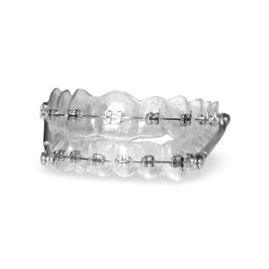 Clear Retainer with Brackets and Herbst Appliance