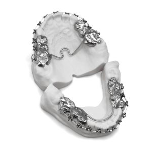 Bracket Appliance with TPA
