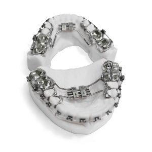 Bracket Appliance with RPE