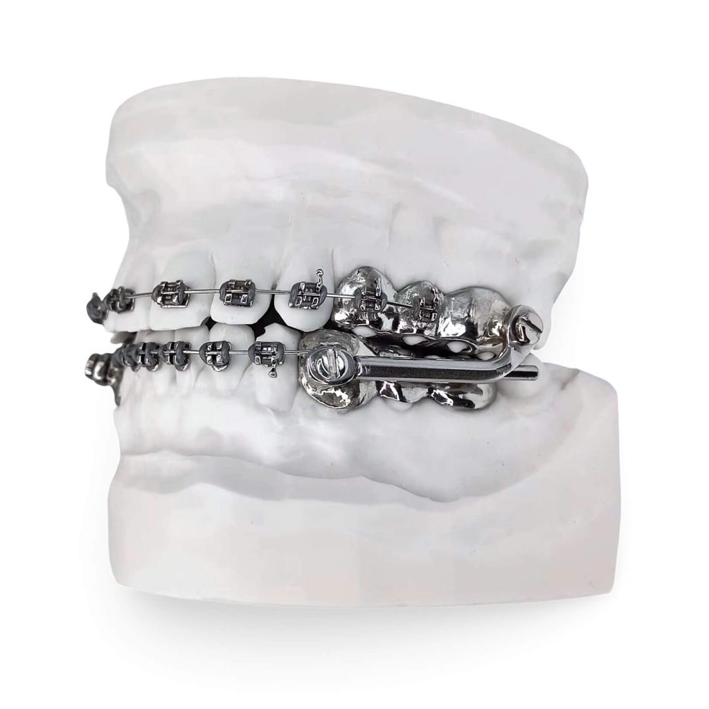 herbst-appliance-with-rpe-and-brackets-bracesshop