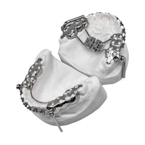 Herbst Appliance with RPE and Brackets